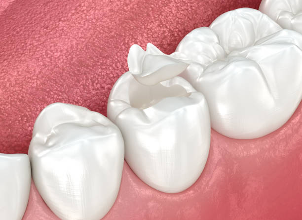 Dental Inlays and Onlays